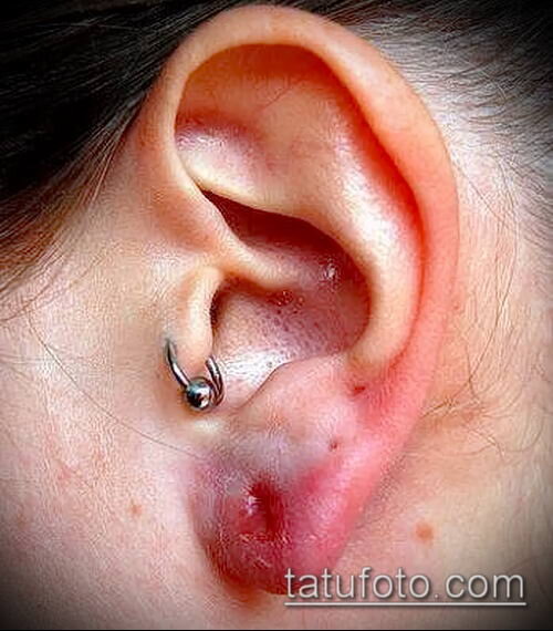 Опухоль мочки уха после неудачного прокола