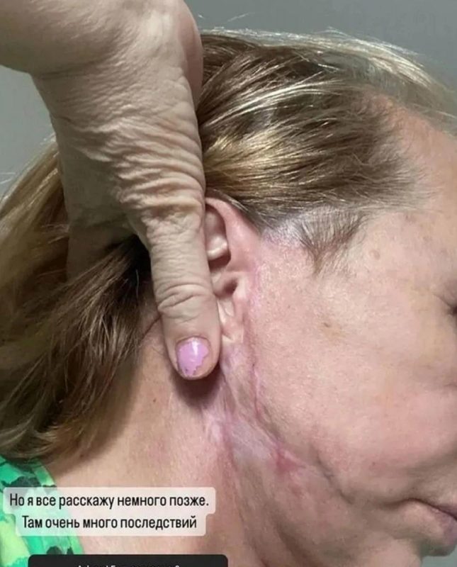   Шрамы на лице Галины Ивановны. Фото: соцсети