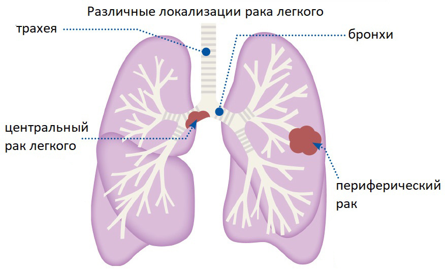 Локализация рака легкого