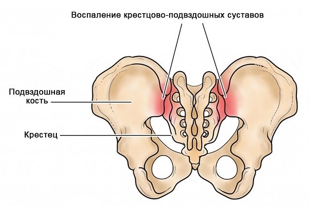 Крестцово-подвздошное сочленение (КПС)