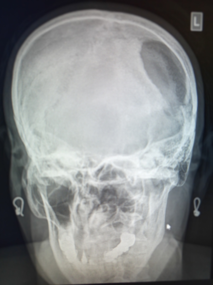 Трепанация в анамнезе.