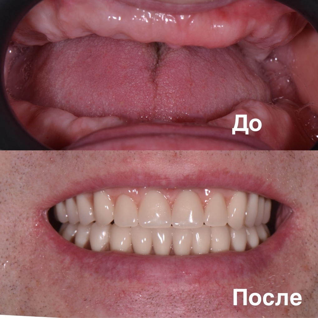 Пример моей работы с протезированием пациента с полным отсутсвием зубов на обеих челюстях