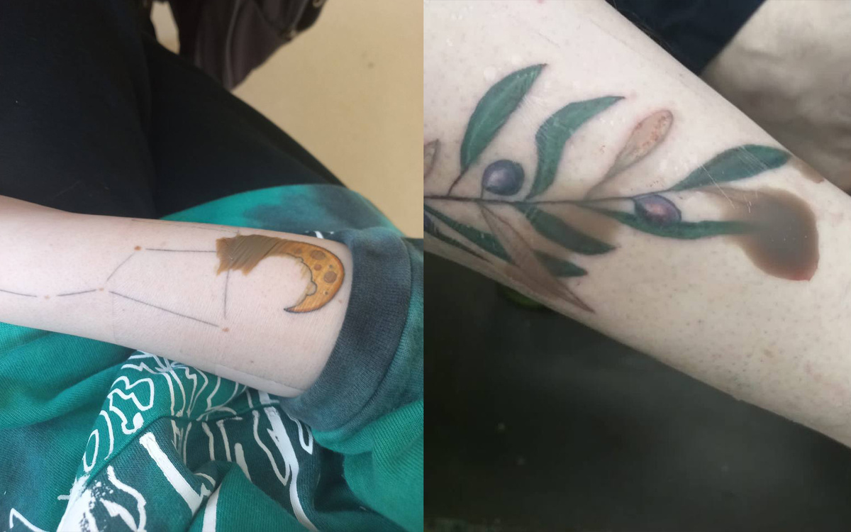 Лимфа и сукровица собираются под заживляющей пленкой. Пленку не нужно протыкать, чтобы удалить жидкость. Оставьте всё как есть — это естественный процесс заживления с использованием защитной пленки.