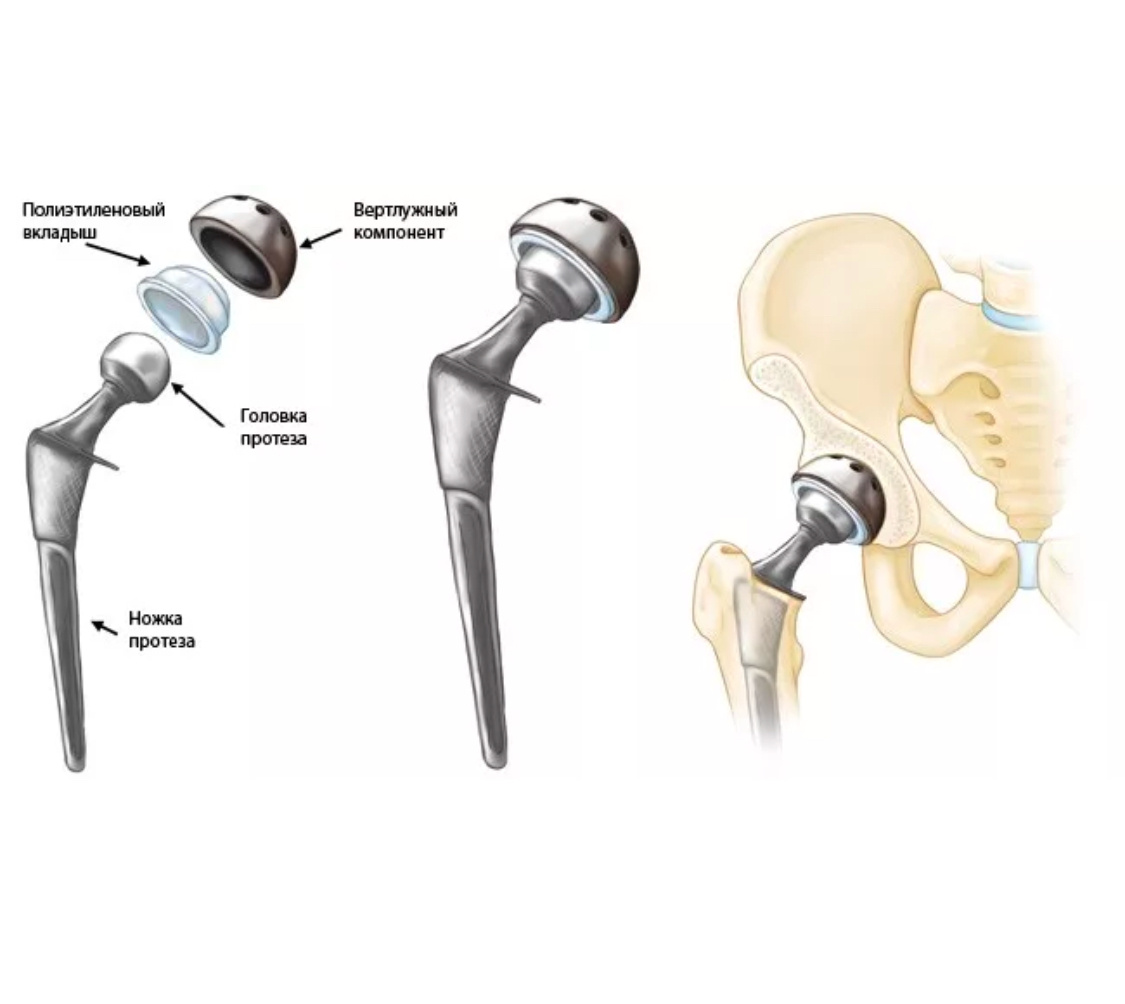 Комплектация эндопротеза