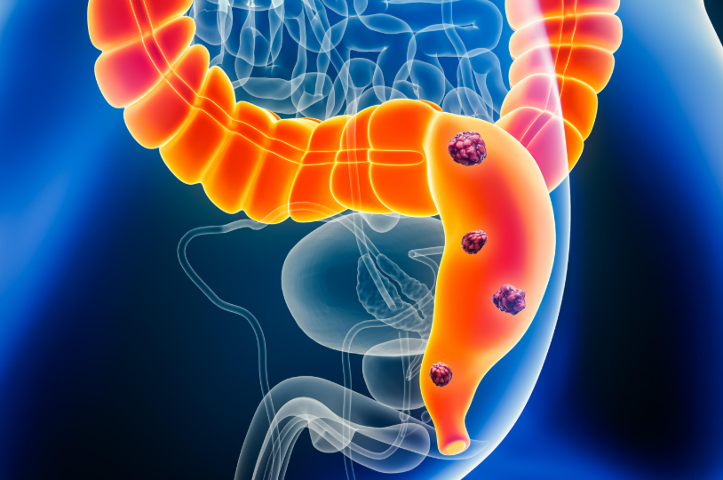 С чего начинается рак толстой кишки