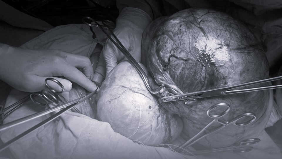    Югорчанке удалили опухоль весом 15 кг