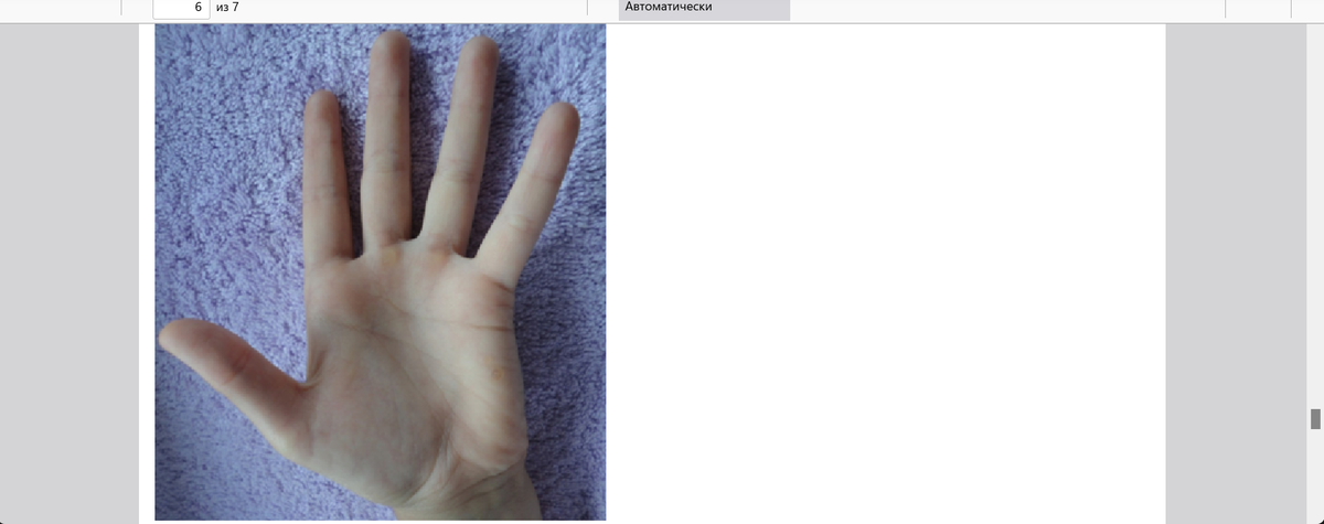 Фото руки девочки с циклоидным типом характера. Фото с моего канала. 