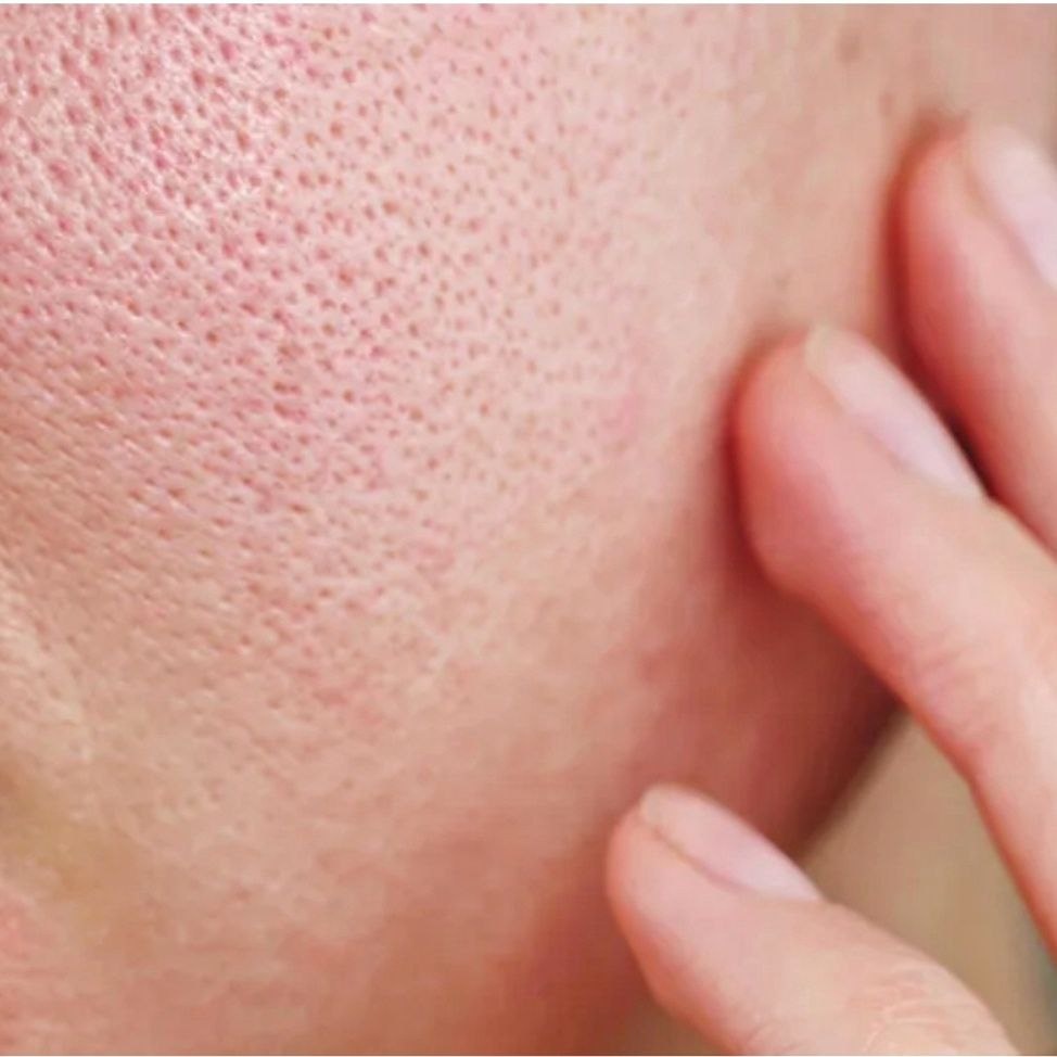 Пример жирной чувствительной кожи, фото взято из открытых источников