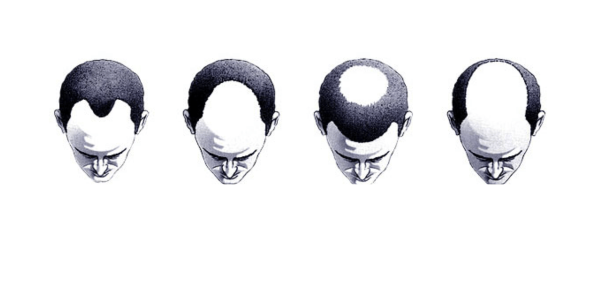 Типы облысения у мужчин