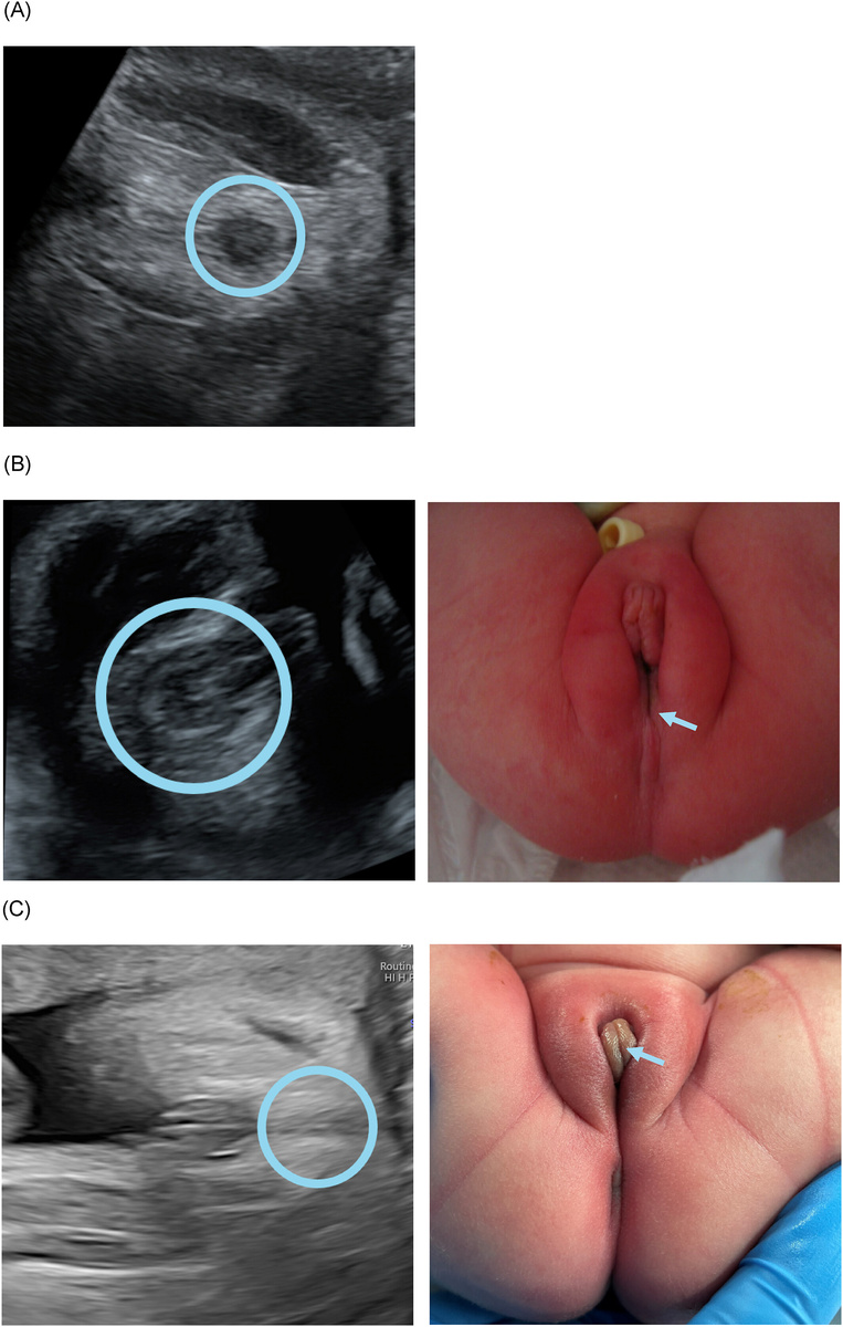 Нормальный, аномальный и отсутствующий "признак мишени" с соответствующим постнатальным изображением.                                                                                                              
(A) Изображение нормального целевого признака.                                                                             (B) Изображение аномального по форме и смещенного кпереди признака мишени, а также соответствующее постнатальное изображение отсутствующего ануса в ожидаемом положении, но с фистулой, которая заканчивается в преддверии (прямокишечно-преддвериевый свищ, синяя стрелка).                                                                                                                                                    
(C) Изображение отсутствующего целевого признака вместе с соответствующим постнатальным изображением порока развития клоаки, при котором мочевыводящие пути, влагалище и прямая кишка имеют один общий канал (синяя стрелка).
