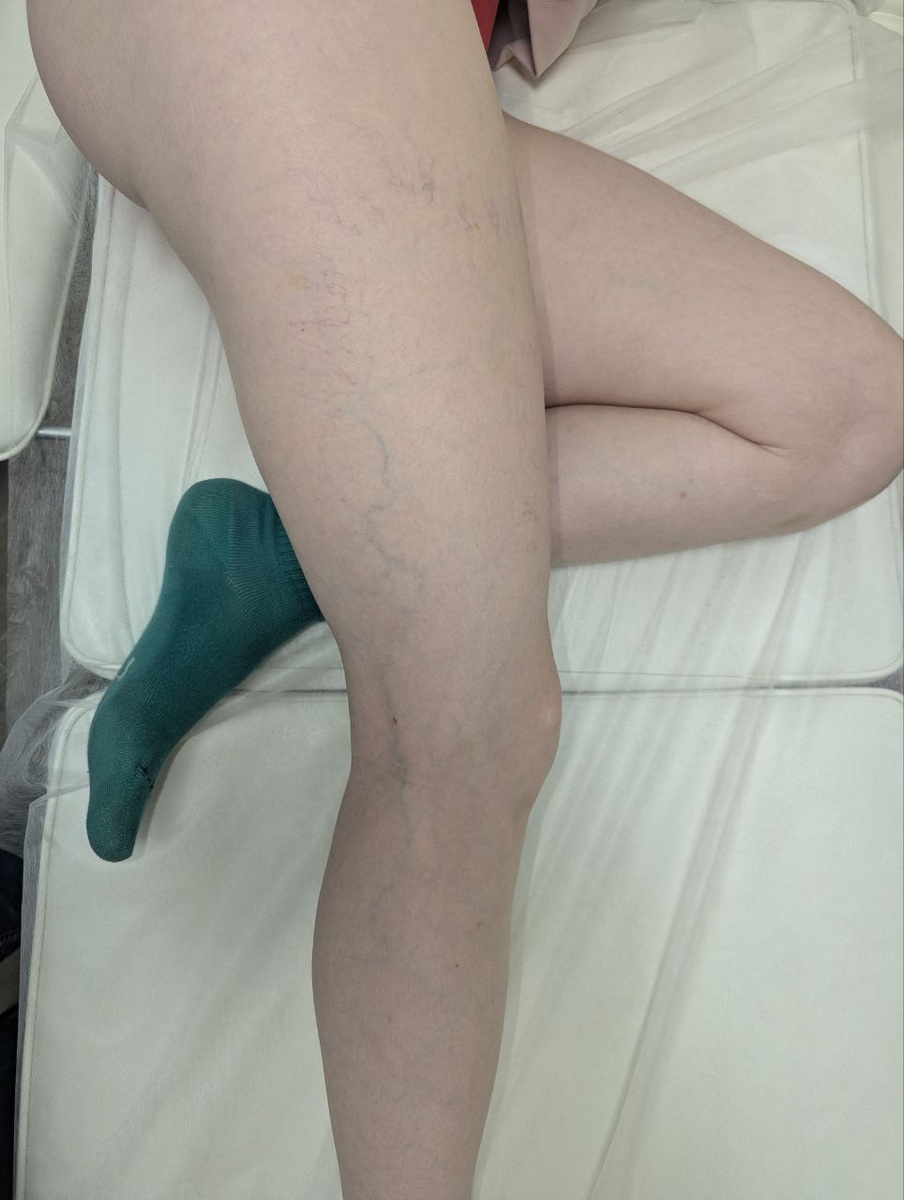 По наружной поверхности голени и бедра видна ретикулярная вена, от которой на бедре веерообразно расходятся сосудистые звездочки