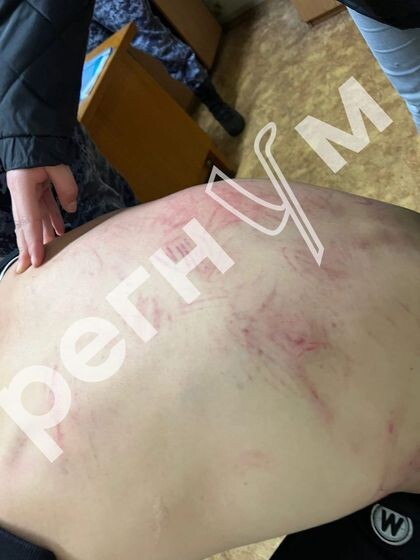 Пострадавший зафиксировал побои, но дело не возбуждали полгода