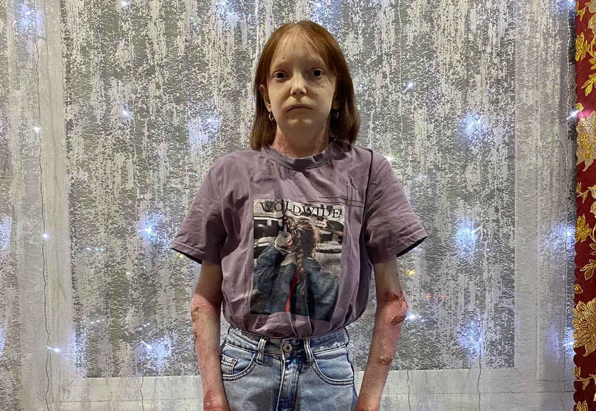 Екатерина, взрослая подопечная фонда «Дети-бабочки»