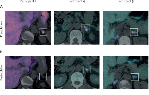 Pre-ablation (A) and post-ablation (B) axial PET-CT overlay images for representative patients