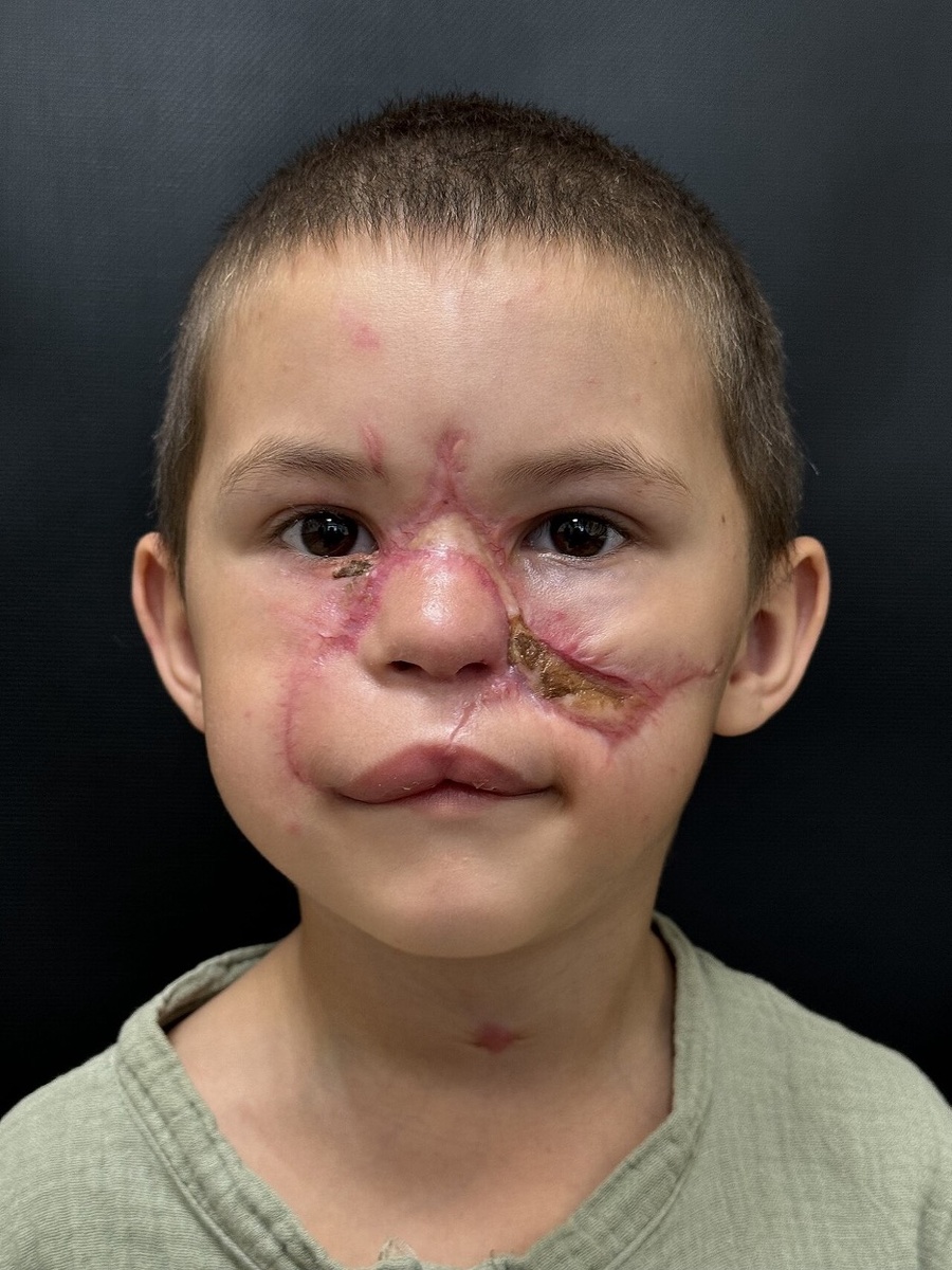 Фото ребёнка после субтотальной реплантации лица