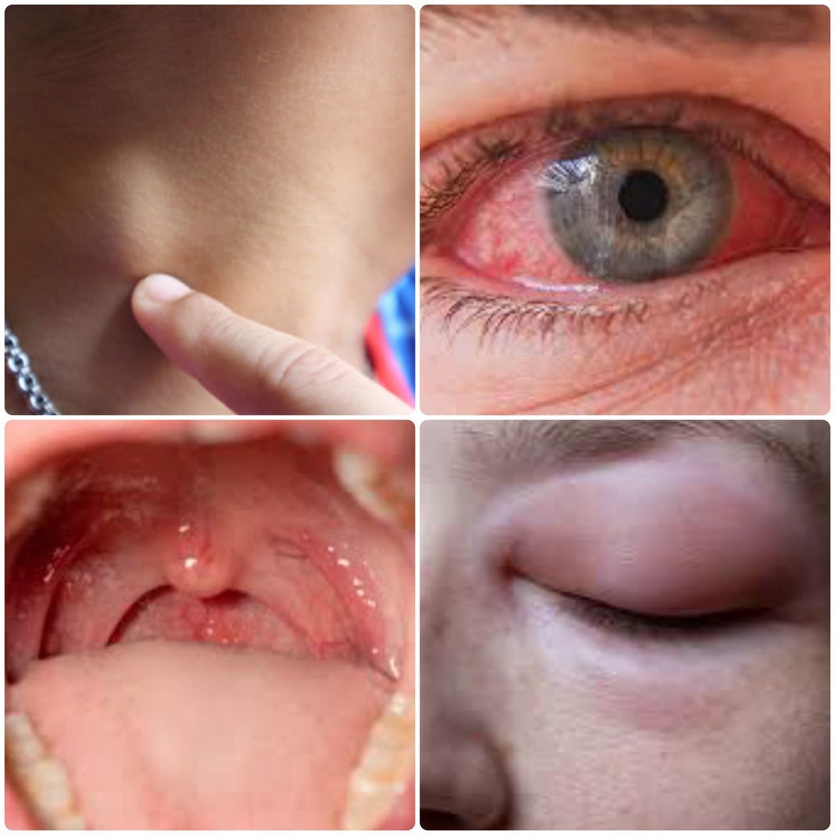 Фарингоконъюнктивальная лихорадка — это заболевание, которое проявляется характерной триадой симптомов: увеличением лимфатических узлов, вирусным конъюнктивитом и лакунарной ангиной или фарингитом. 