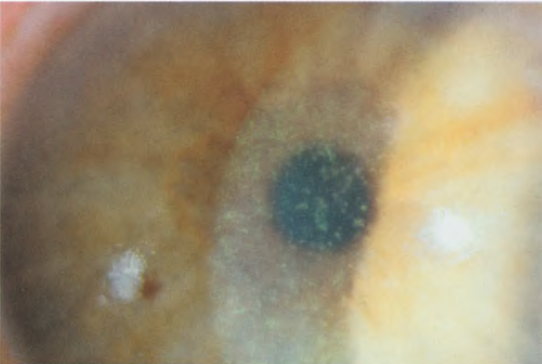 Центральный точечный кератит