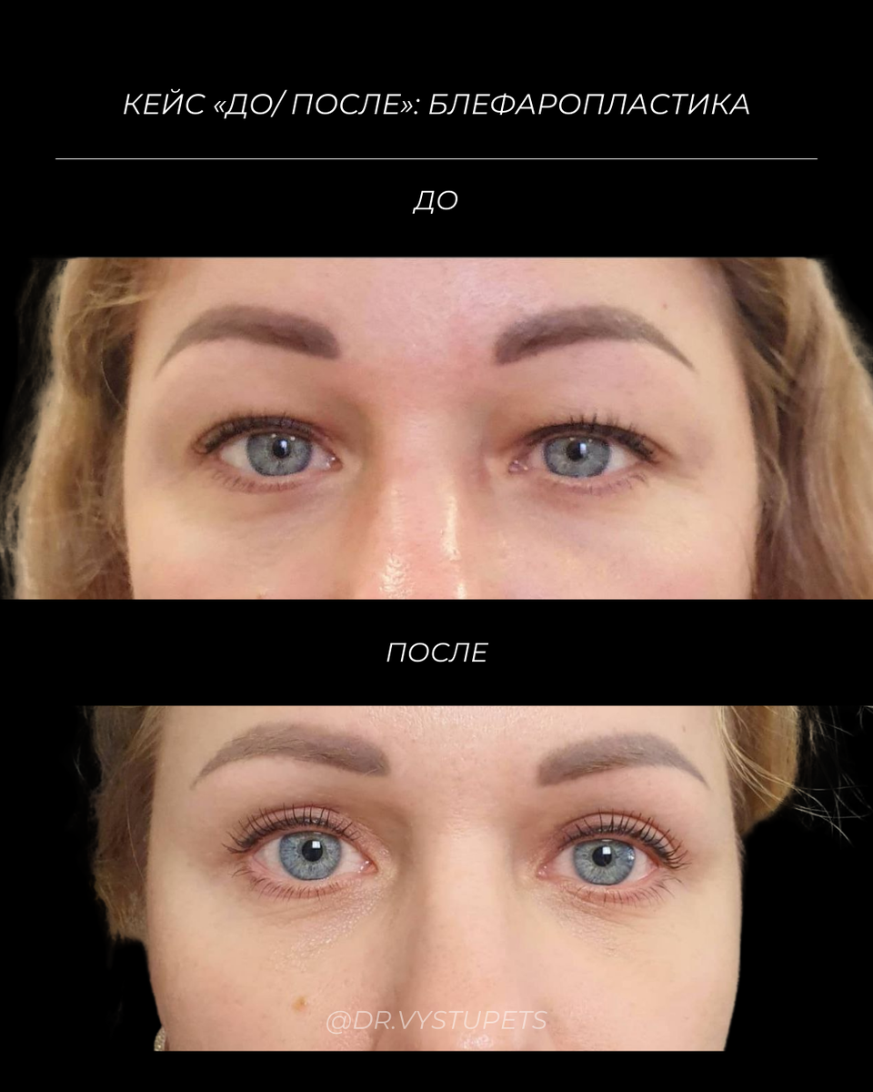 Кейс "До/ После": блефаропластика. Выполнил Борис Владимирович Выступец, пластический хирург клиники MEDALL, к.м.н.