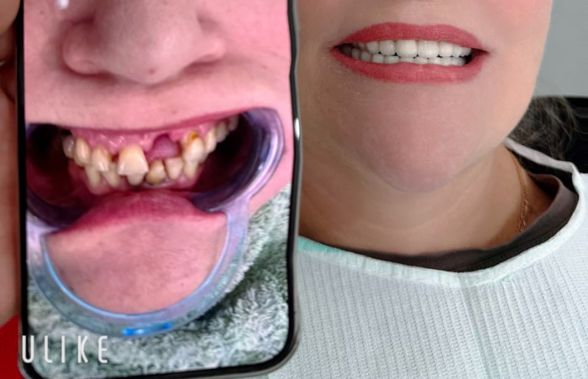 28 коронок. Металлокерамика. Стоматология №1 Хэйхэ