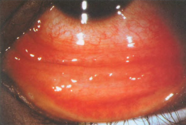 диффузная конъюнктивальная инъекция с выраженным фолликулезом, более заметном на нижнем веке