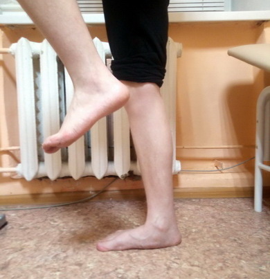 продольное поскостопие 3 ст.