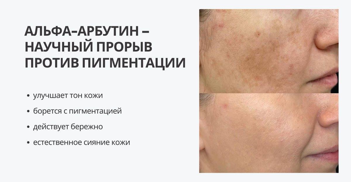 Альфа-арбутин – научный прорыв против пигментации. Почему он работает? 