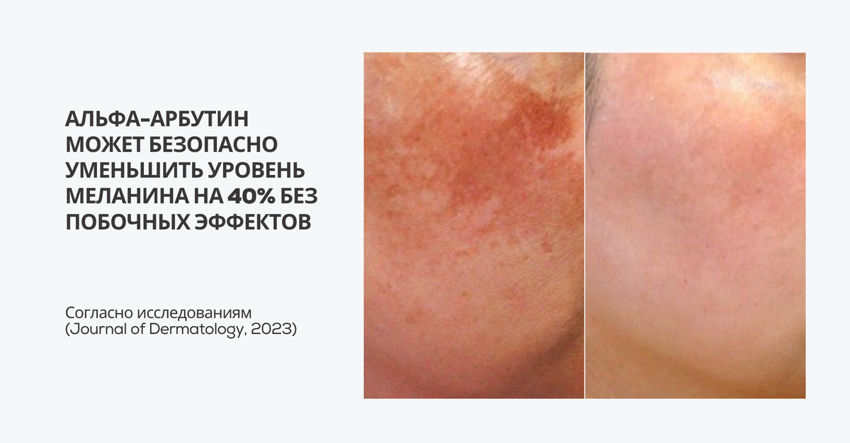 Как альфа-арбутин осветляет кожу и борется с пигментацией