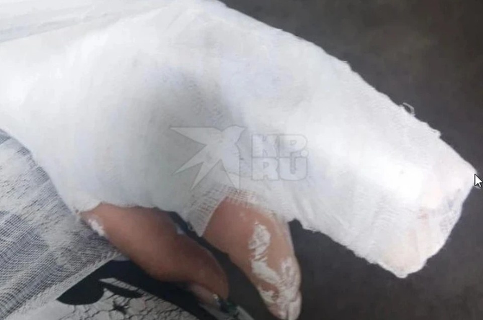    У женщины диагностировали перелом руки. Фото: предоставлено читателем КП-Екатеринбург.