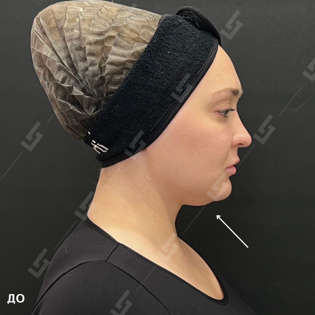 До процедуры фейстайт