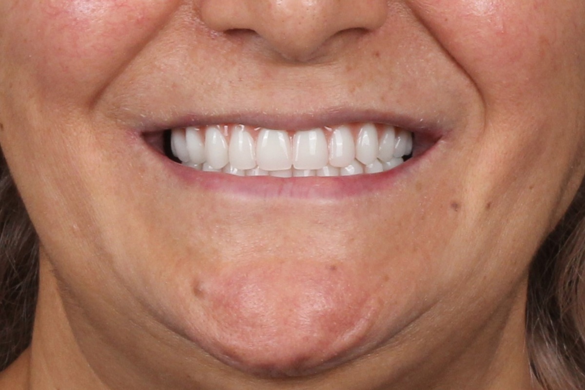 Временные протезы по концепции All-on-6