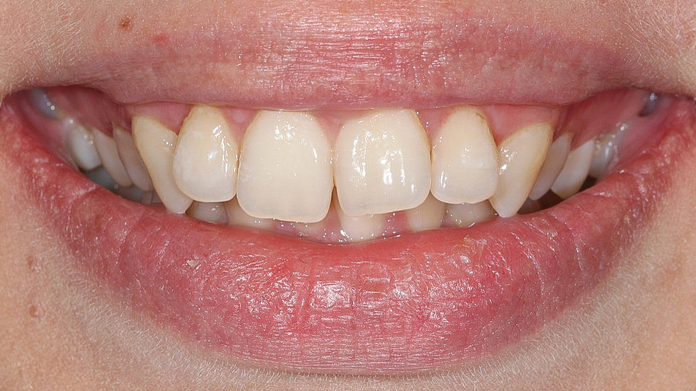 Улыбка Алены ДО 