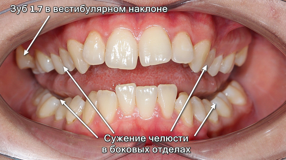 Зубы пациентки до начала лечения