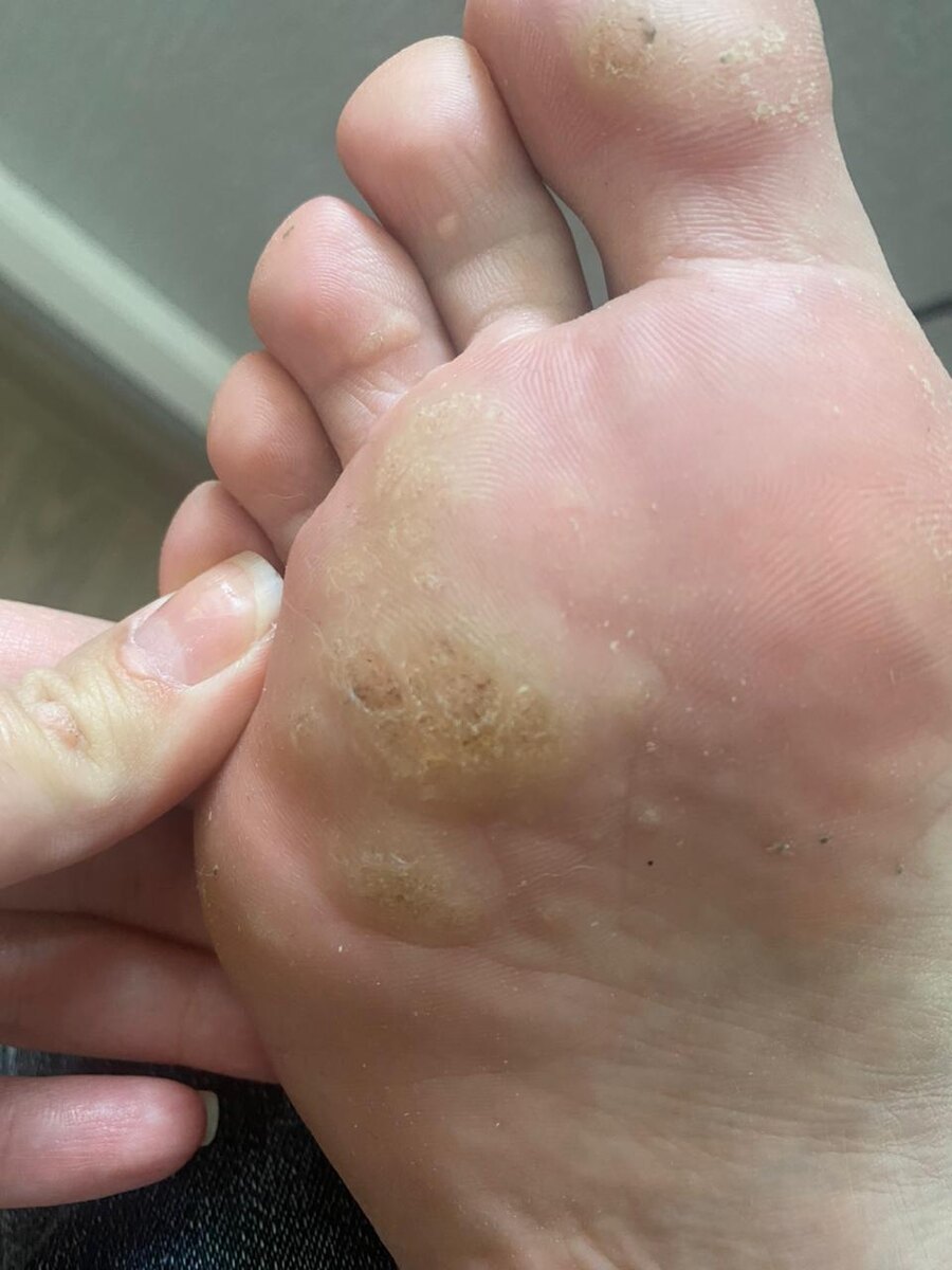 Сочетание подошвенных бородавок и плоских на руках