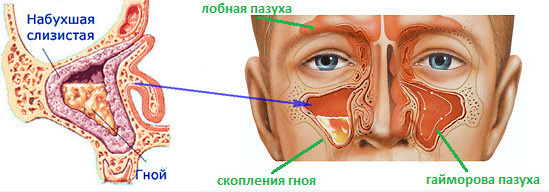 Воспаление верхнечелюстной пазухи