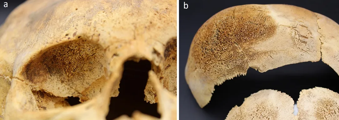 Изменения костей, обнаруженные на некоторых скелетных останках в QCC, включая (a) Cribra orbitalia (ZAC 623); (b) поротический гиперостоз (ZAC 534). 