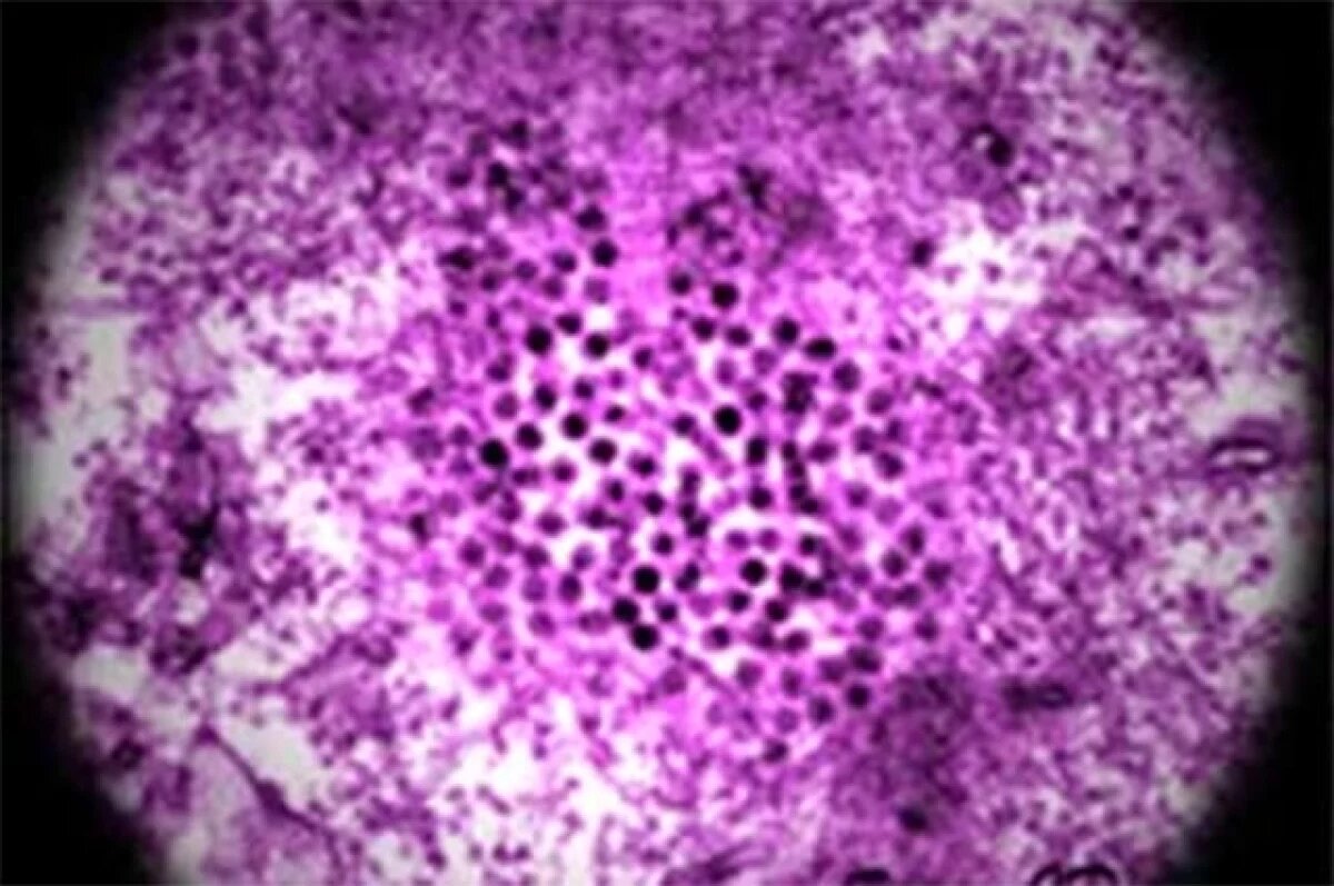    Роспотребнадзор предупреждает рязанцев о случаях лихорадки Западного Нила