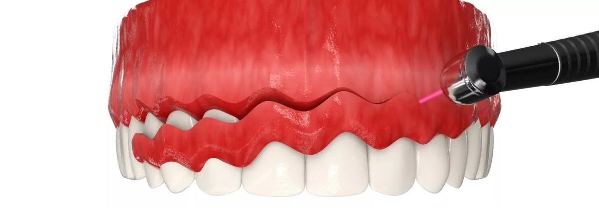 Резекция десны с помощью лазера