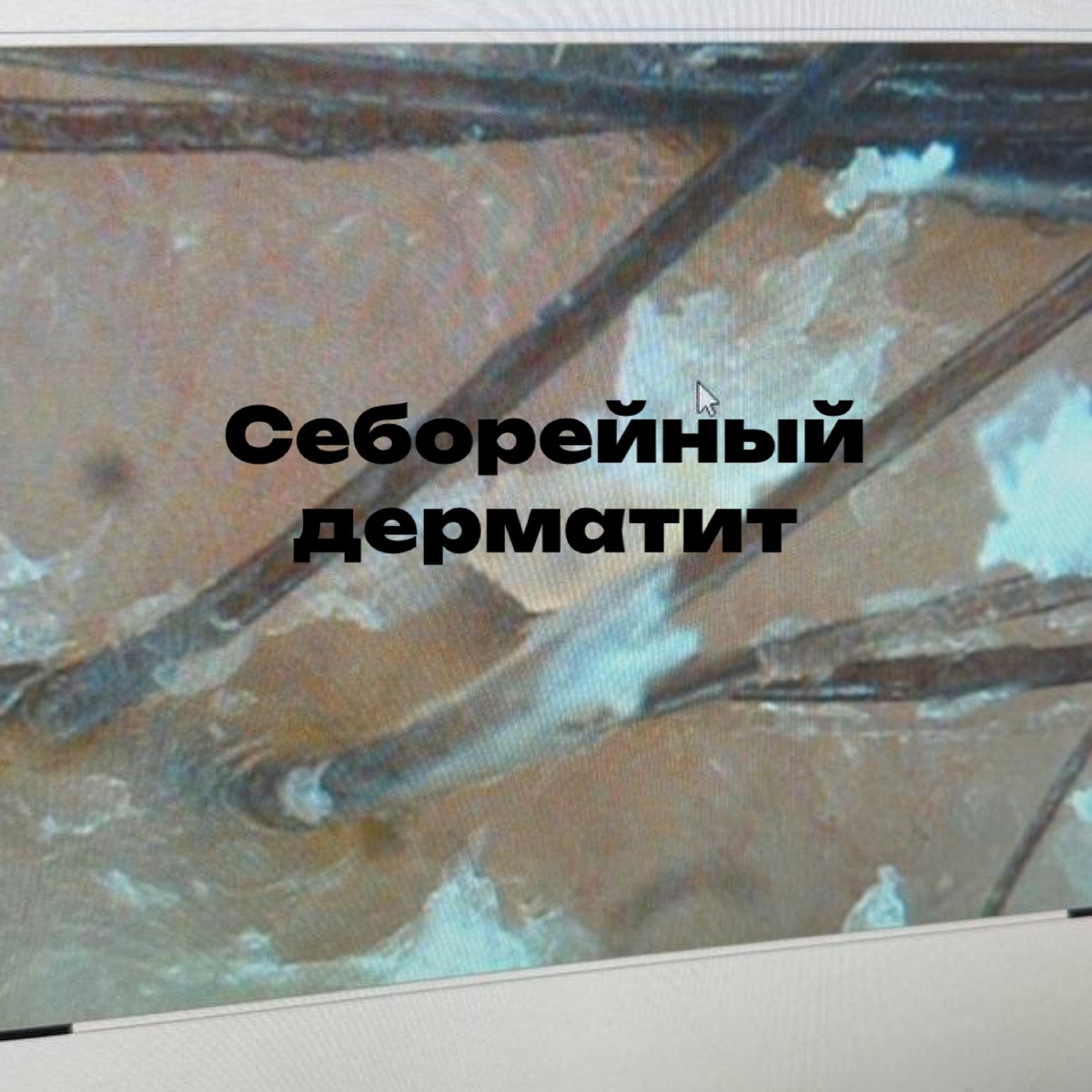 Трихоскопическая картина 