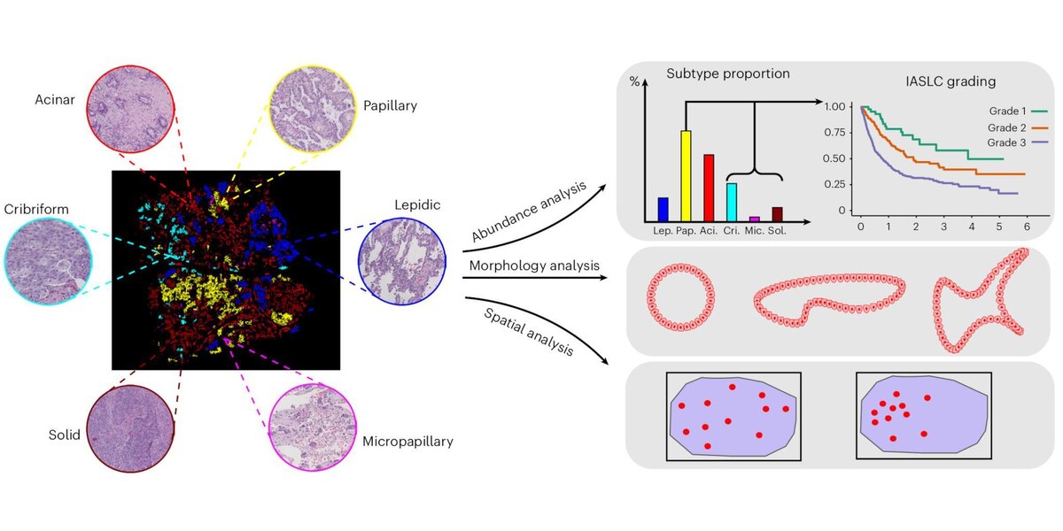 Анализ нисходящего течения, проводимые с помощью метода AI, включая количественную оценку численности, стратификацию риска, анализ морфологической и пространственной неоднородности.