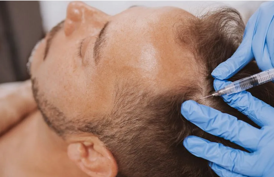 PRP- терапия после пересадки волос: преимущества процедуры
