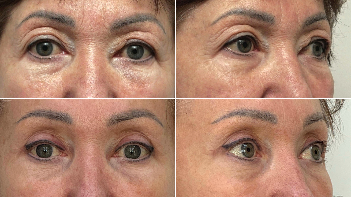 Пластическая операция - периорбитопластика, пластический хирург Стайсупов В.Ю.