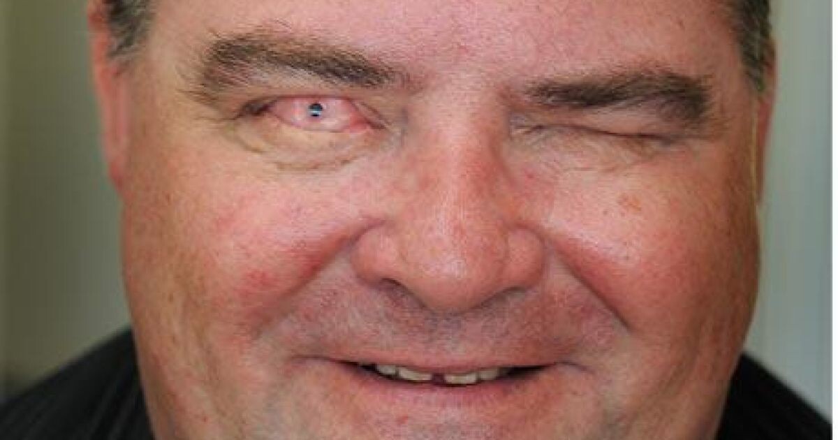 Мартин Джонс — англичанин, которому провели остео-одонто-кератопротезирование