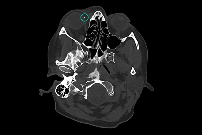 Кальцинат в области глазницы.