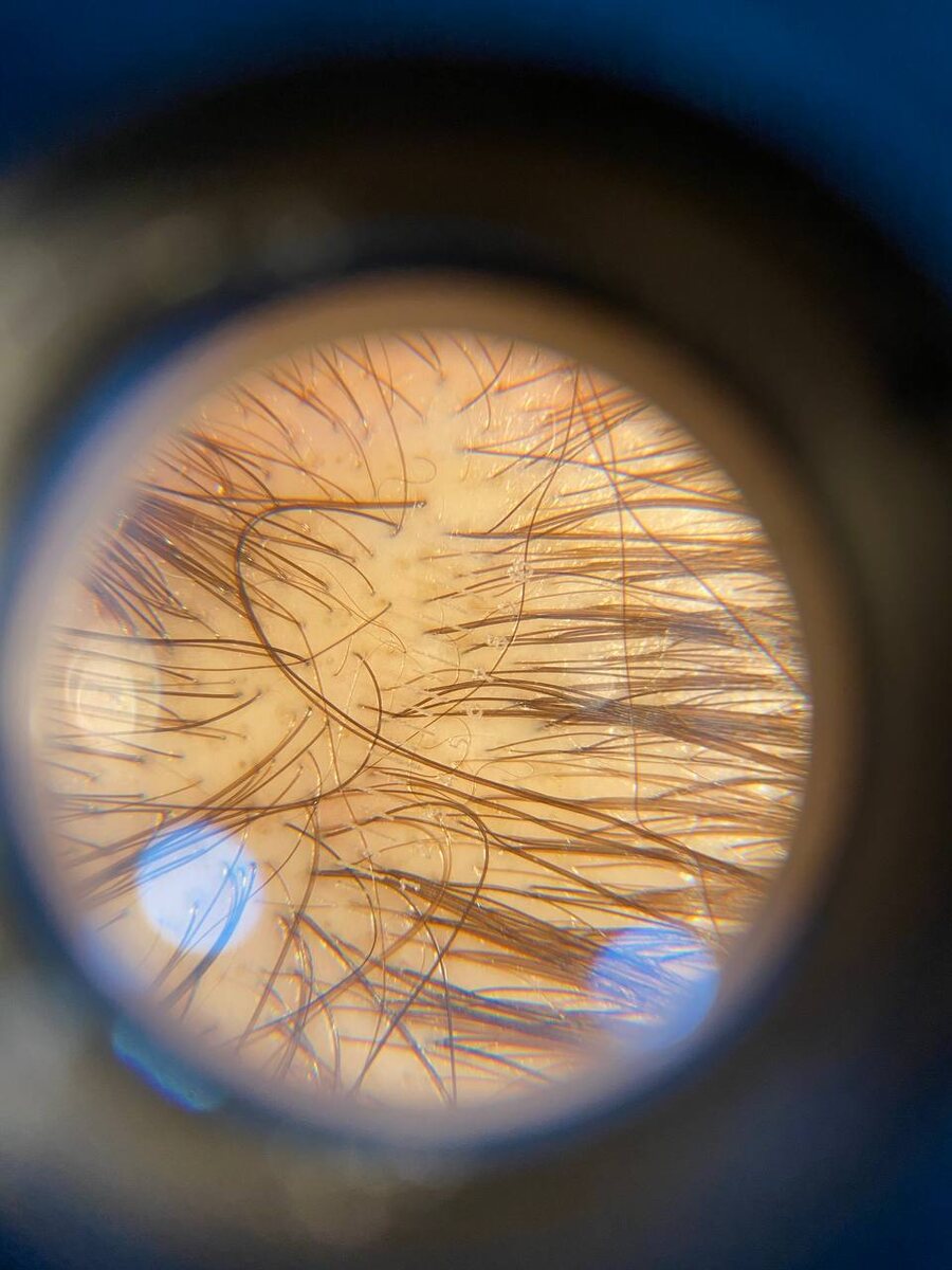 При трихоскопии видны новые тонкие волосы и молодые «пеньки», а так же гиперпигментация кожи у выхода волосяного стержня, которая свидетельствует о благоприятном процессе роста волоса и жизнеспособности фолликула🧅