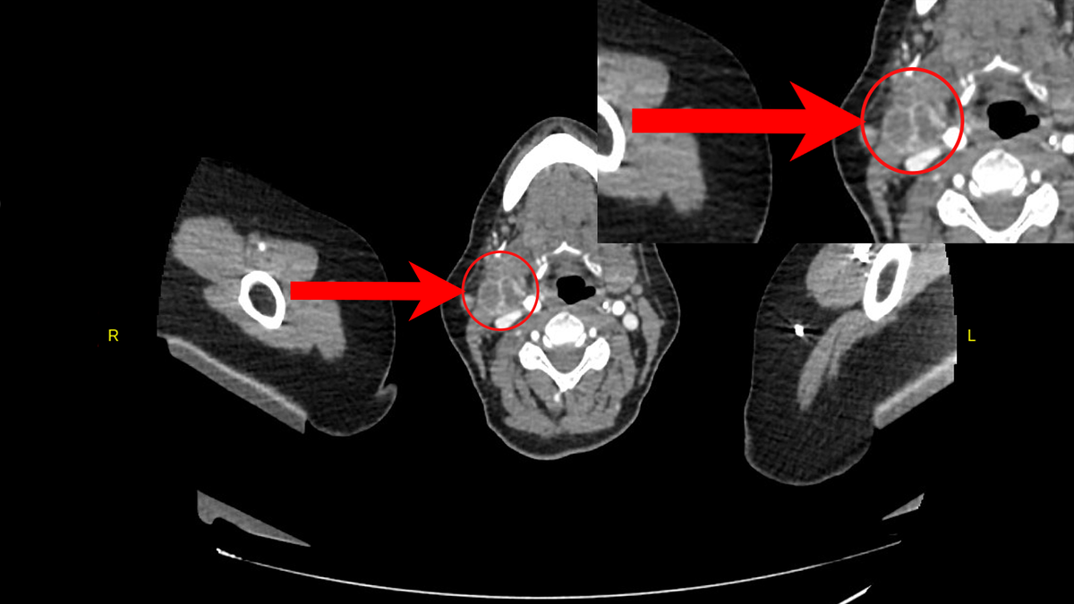Конгломерат увеличенных подчелюстных лимфоузлов на КТ.