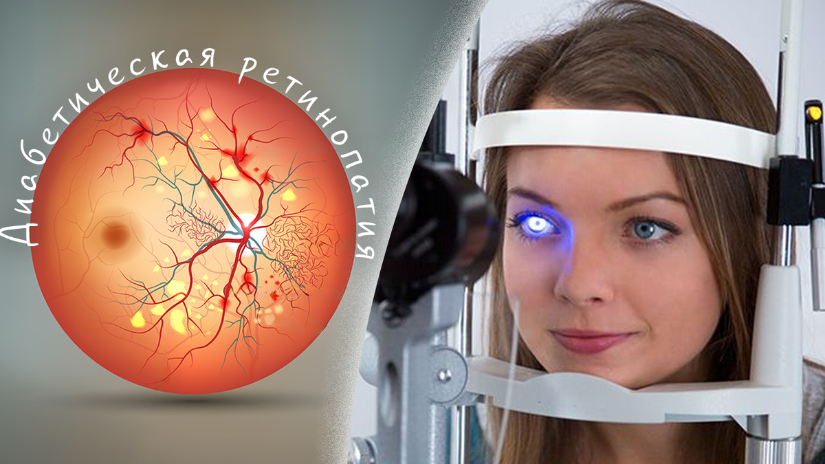 Диабет и зрение - когда сахар бьет по глазам: все, что нужно знать о диабетической ретинопатии. Признаки, лечение и профилактика 👁️
