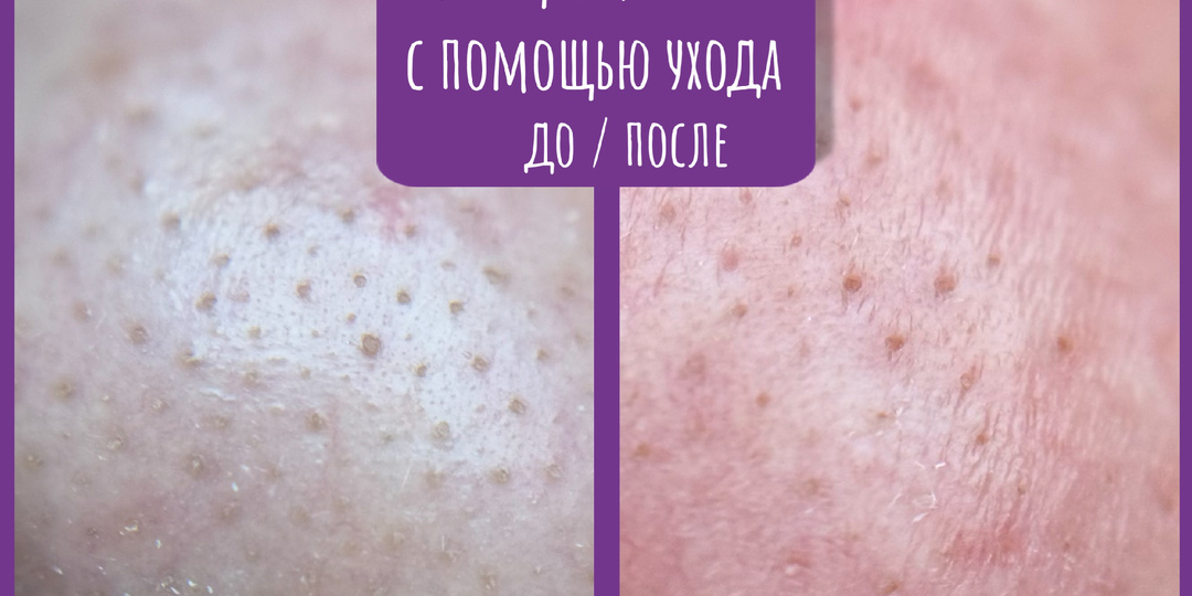 Как я победила черные точки без боли? Мой личный опыт и научные лайфхаки