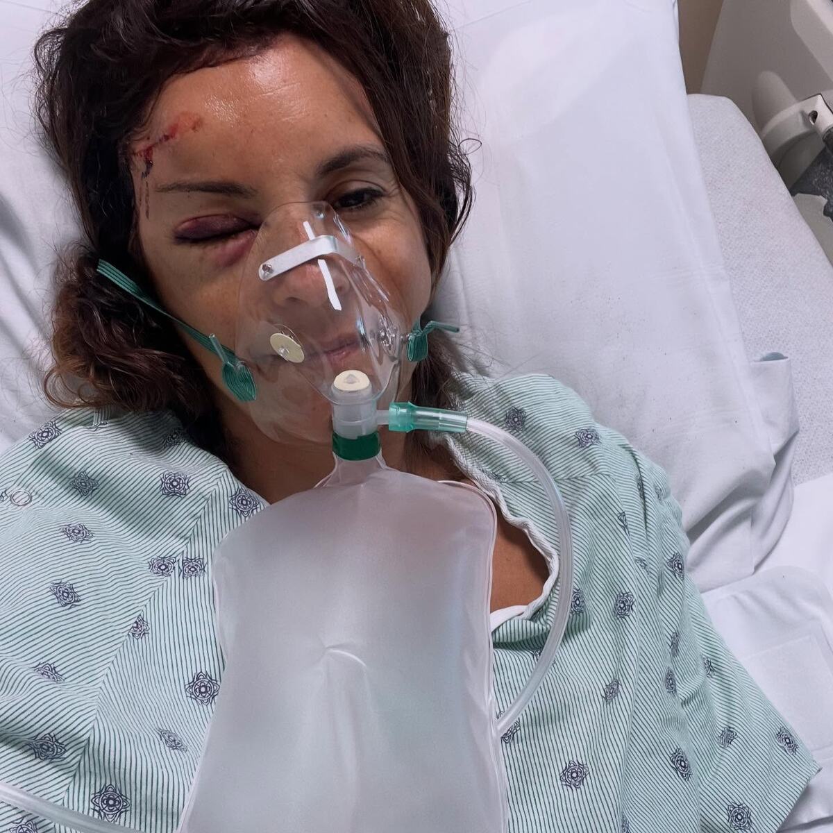 Марион Грожан после ДТП на велосипедеФото: Соцсети  📷
