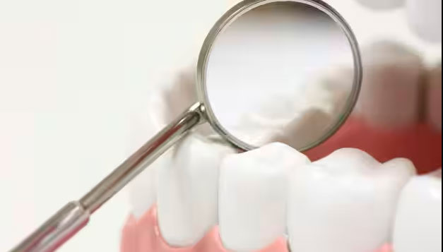 Эрозия зубов — это видимый износ и потеря структуры зубов