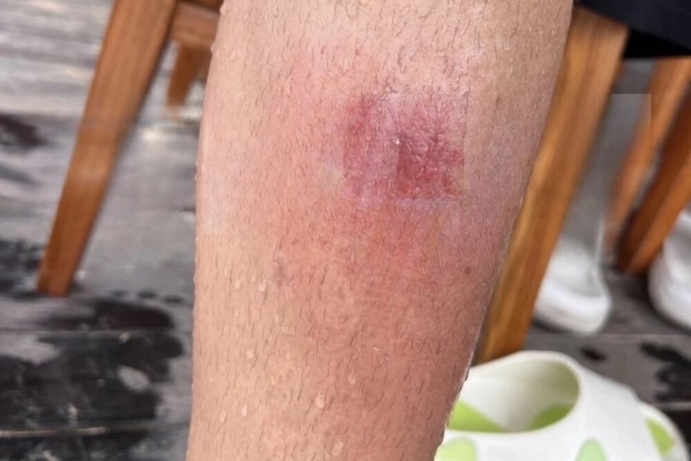    Кожа покрывается красными пятнами и точками. Фото: соцсети